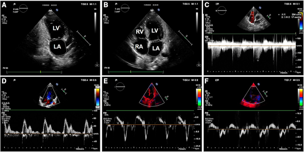 Six echocardiogram panels show heart chambers and Doppler measurements of blood flow through the heart.