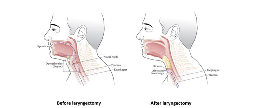 Depiction of pre- and post-surgical appearance of the head and neck after a total laryngectomy.