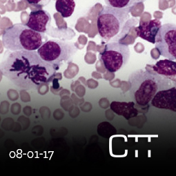 Jing Fang - leukemia