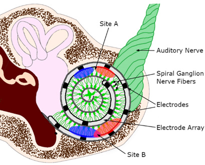 Cochlear Chart 