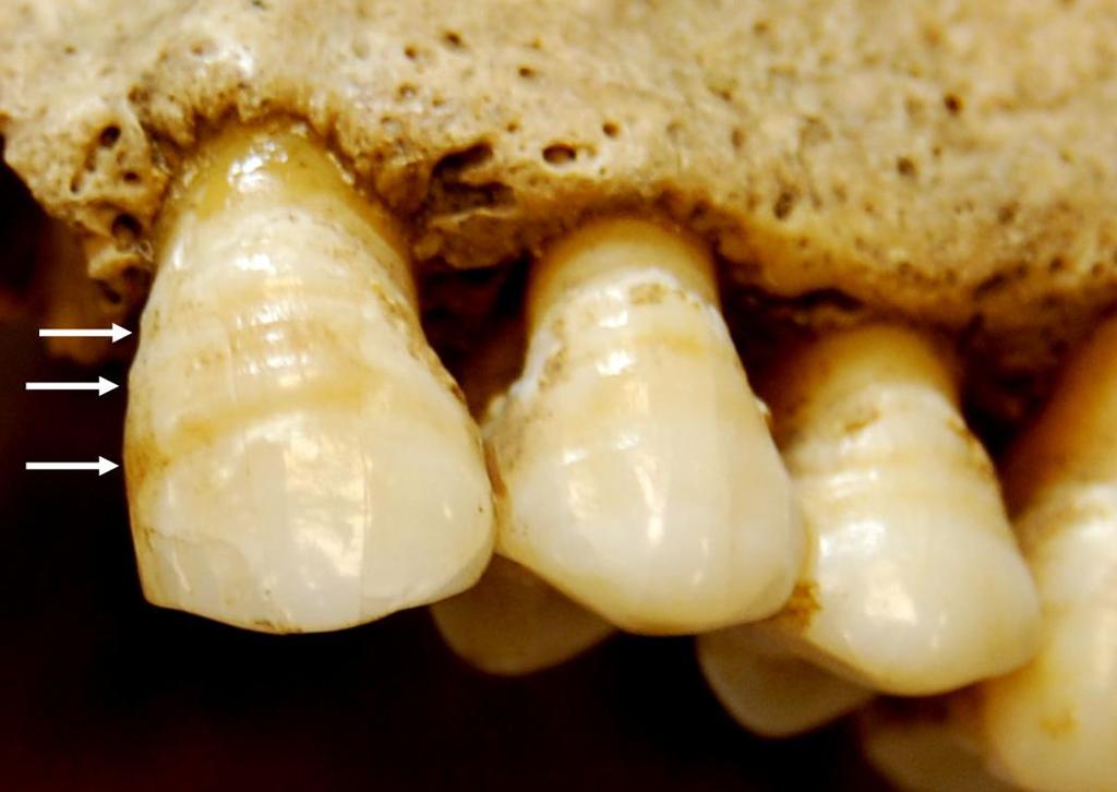 DeWitte examines teeth for linear enamel hypoplasia, or little horizontal grooves that form when children's enamel formation is interrupted by malnutrition or infectious disease. 