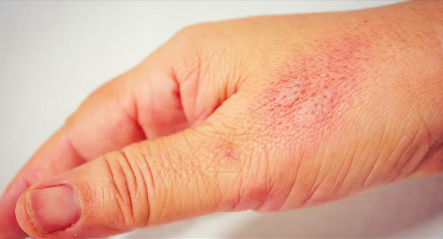 A hand with an inflamed bug bite