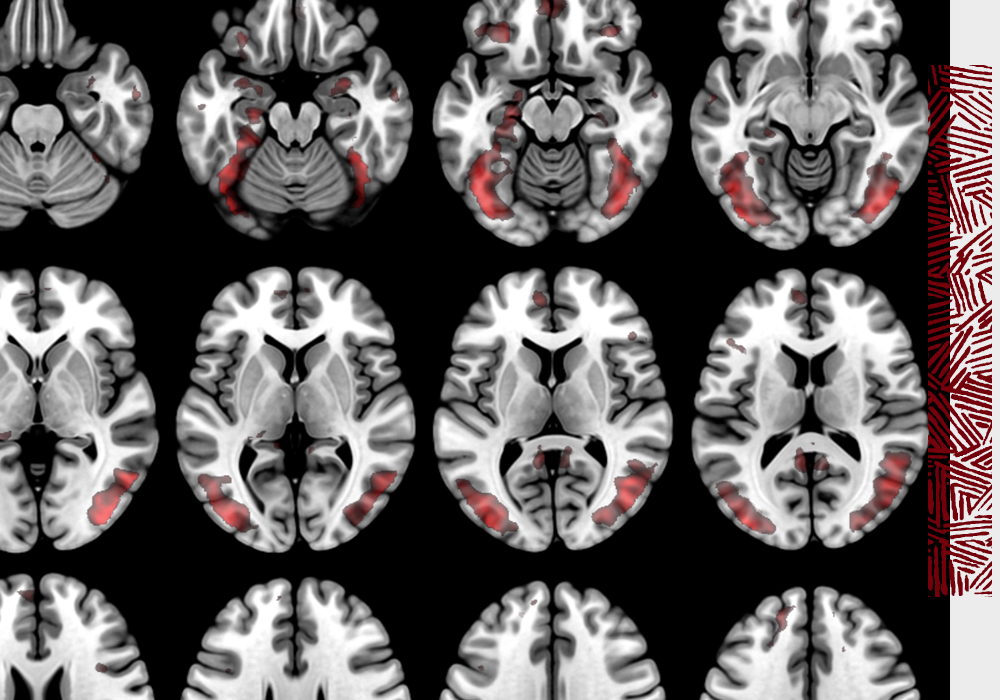 Multiple black and white scans of a brain with red highlights.
