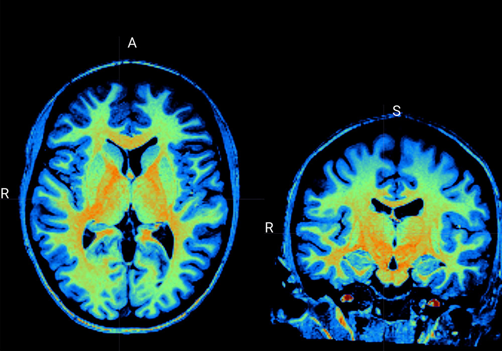 Multicolored brain scan