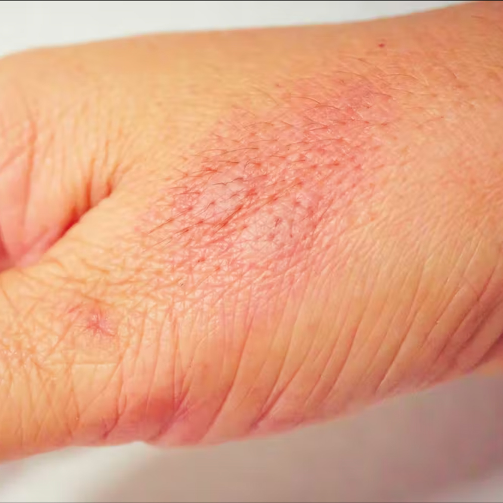 A hand with an inflamed bug bite