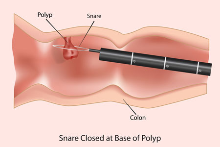 Precancerous growths called polyps being removed during a colonoscopy