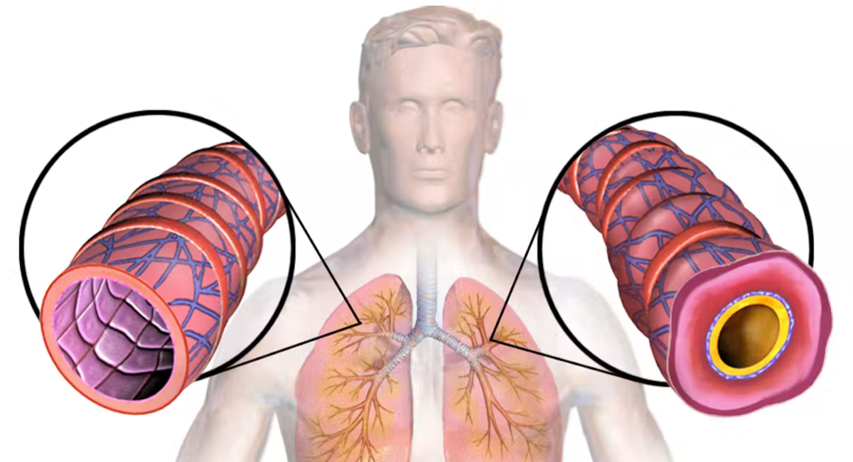 A diagram of a healthy lung and a lung with asthma